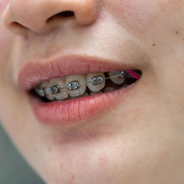 Braces in teenage girl mouth to treat and beauty for increase confidence and good personality